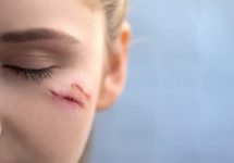 Scarring and Disfigurement Lawsuits