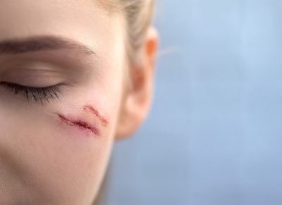 Scarring and Disfigurement Lawsuits